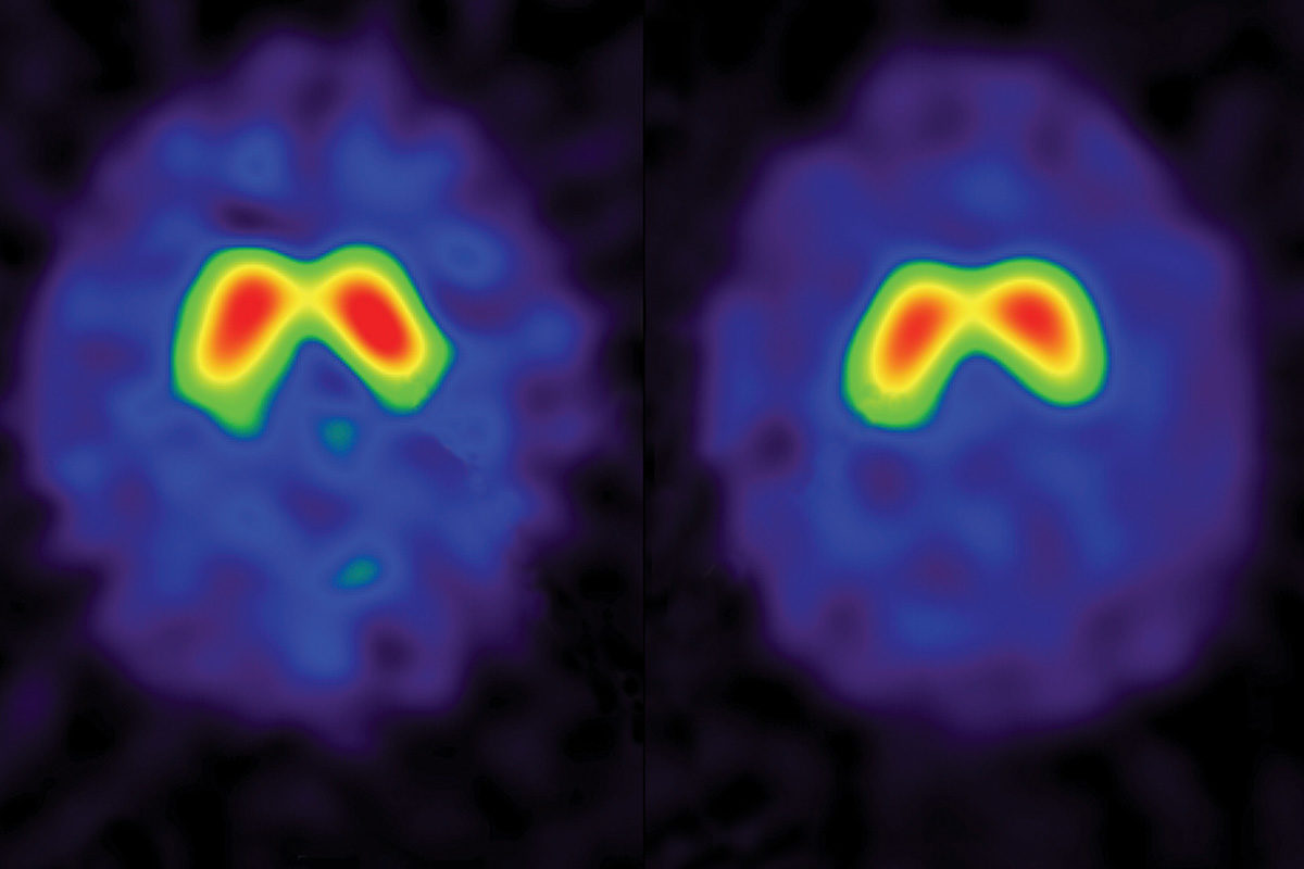 SPECT scans of author Trisha Elliott’s brain before (left) and after (right) a week-long silent retreat. The coloured areas in the scans show the basal ganglia region of the brain. From blue to red, the shades represent the intensity of uptake of dopamine in the basal ganglia. The red area in the post-retreat image is smaller, indicating that fewer transporters are carrying the “feel-good” neurotransmitter away. Courtesy of Andrew Newberg