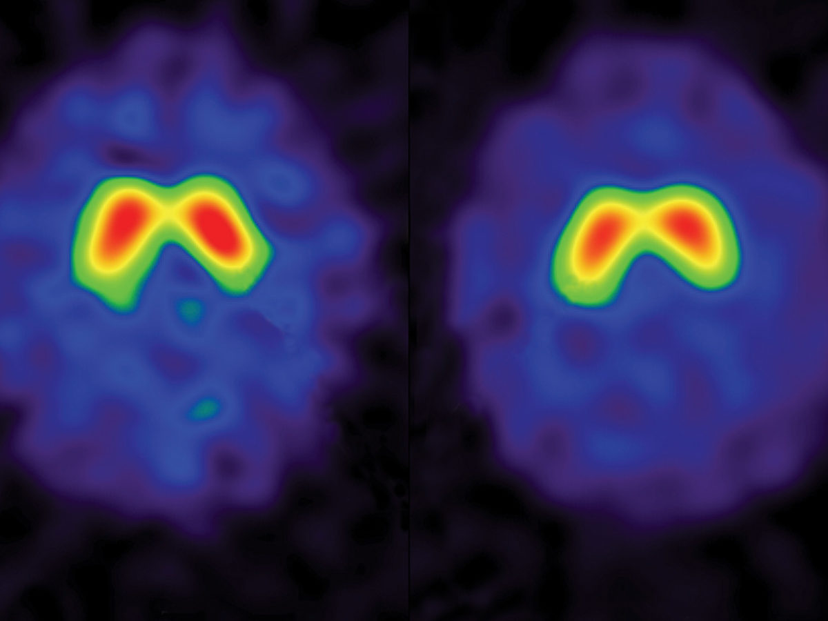 SPECT scans of author Trisha Elliott’s brain before (left) and after (right) a week-long silent retreat. The coloured areas in the scans show the basal ganglia region of the brain. From blue to red, the shades represent the intensity of uptake of dopamine in the basal ganglia. The red area in the post-retreat image is smaller, indicating that fewer transporters are carrying the “feel-good” neurotransmitter away. Courtesy of Andrew Newberg